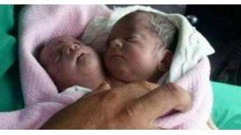 Nació un bebé con dos cabezas en Siria Nació un bebé con dos cabezas en Siria