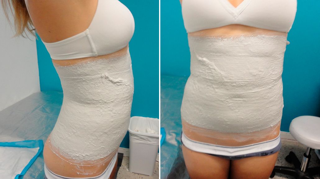 Yesoterapia para adelgazar antes y despues de adelgazar