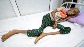 Saida Ahmad Baghili internada en un hospital de Yemen con desnutrición aguda Saida Ahmad Baghili internada en un hospital de Yemen con desnutrición aguda