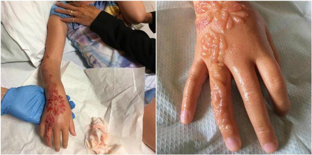 Madison Gulliver sufrió severas quemaduras<br>