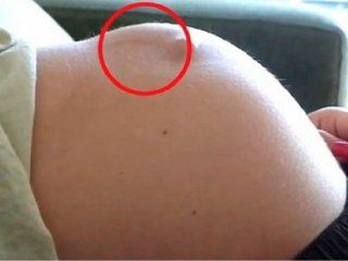increible: un bebe le perforo el utero a su mama de una patada increible: un bebe le perforo el utero a su mama de una patada