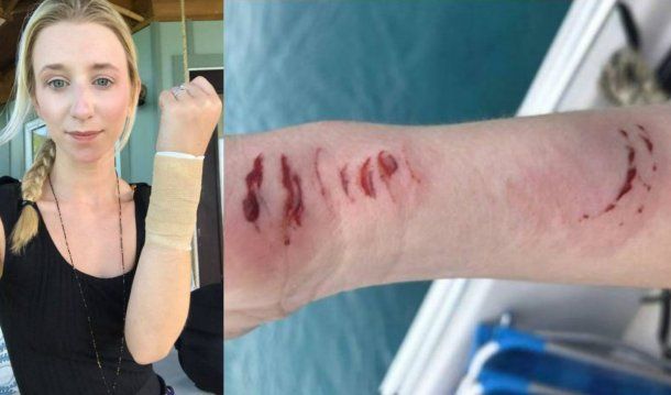 El tiburón mordió a Illig, pero la mujer tuvo mucha suerte
