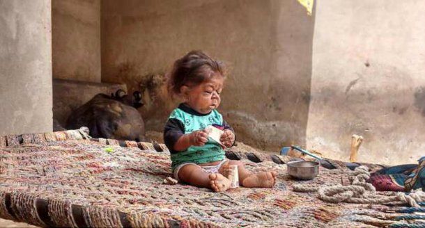 Manpreet pesa apenas 5 kilos, lo mismo que un bebé de tres meses