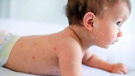 Alerta en la Ciudad: se detectaron 2 casos de sarampión en bebés Alerta en la Ciudad: se detectaron 2 casos de sarampión en bebés