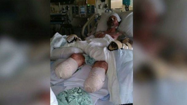 Manteufel perdió sus piernas y brazos por una infección en la sangre transmitida por su perro
