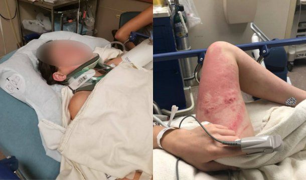 La adolescente tiene cinco costillas rotas y una lesión en el pulmón por el impacto contra el agua