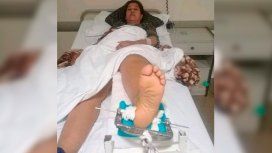 La mujer está internada con una fractura en la pierna izquierda La mujer está internada con una fractura en la pierna izquierda