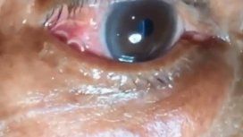 Asqueroso: le creció un gusano en el ojo por la picadura de un mosquito Asqueroso: le creció un gusano en el ojo por la picadura de un mosquito
