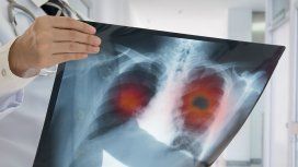 El cáncer de pulmón es el que más muertes por año causa en la Argentina. El cáncer de pulmón es el que más muertes por año causa en la Argentina.