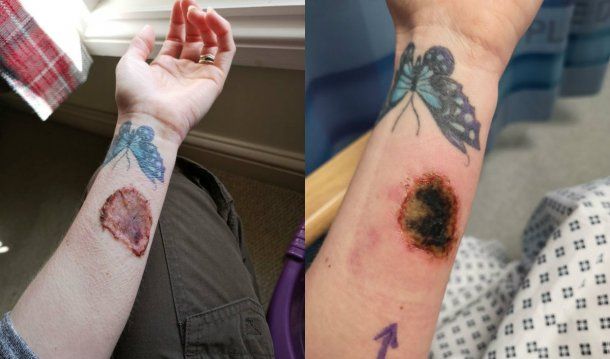 Izquierda: el brazo de Becky tras la operación. Derecha: la quemadura por limpiahorno<br>