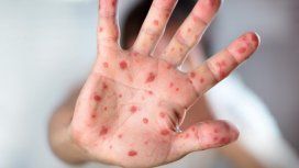 Hay alerta epidemiológica en la Ciudad por un caso de rubéola Hay alerta epidemiológica en la Ciudad por un caso de rubéola
