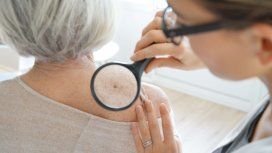 Crecieron 20% las consultas por cáncer de piel: cómo cuidarse del sol Crecieron 20% las consultas por cáncer de piel: cómo cuidarse del sol