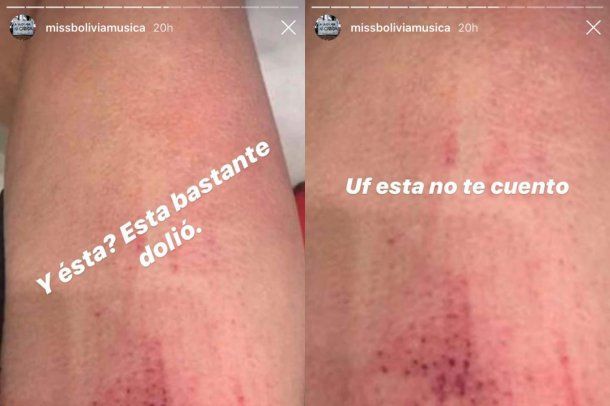 Miss Bolivia mostró varias fotos con lesiones que habrían sido inflingidas por su expareja al acusarlo de violencia de género.