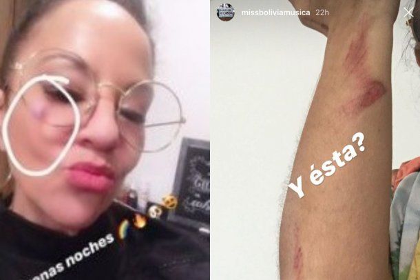 Miss Bolivia mostró varias fotos con lesiones que habrían sido inflingidas por su expareja al acusarlo de violencia de género.