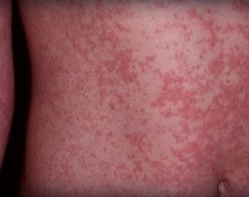 El 80% con erupciones en la piel