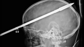 Radiografía del adolescente que recibió un arponazo Radiografía del adolescente que recibió un arponazo