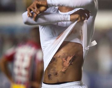 Jonathan Copete hizo tres goles en Santos e impresionó con quemaduras en su cuerpo