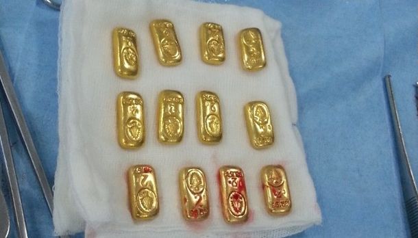 Lo operaron de urgencia por dolor abdominal y le encontraron un valioso cargamento