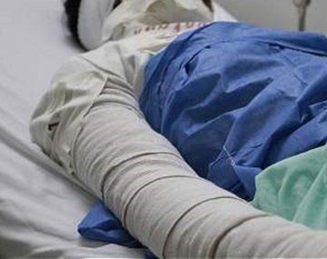 Internaron a una mujer con 80% del cuerpo quemado tras un intento de femicidio