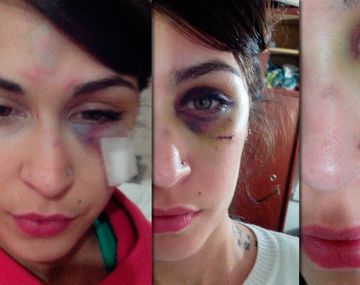 En primera persona: su ex la golpeó por celos y lo contó por Facebook