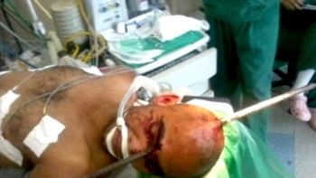 sobrevivio a una perforacion de craneo con una barra de acero sobrevivio a una perforacion de craneo con una barra de acero