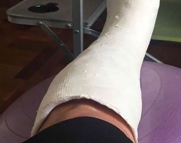 ¿Venden un yeso trucho para no ir a trabajar y ver el Mundial?