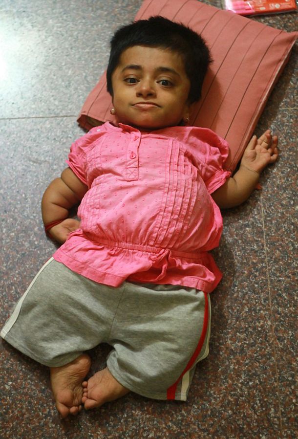 Tiene 19 años pero está atrapada dentro del cuerpo de una niña de 2