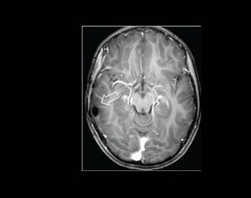 Una chica de seis años no podía parar de reírse debido a un tumor cerebral