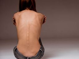 Trastornos alimenticios: es la tercera enfermedad crónica más común entre las jóvenes