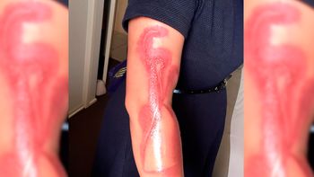 Una mujer asegura que el iPhone le generó quemaduras de segundo grado Una mujer asegura que el iPhone le generó quemaduras de segundo grado