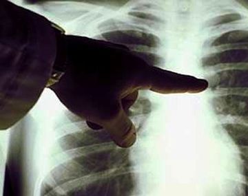 Investigadores encuentran la posible cura del cáncer de pulmón