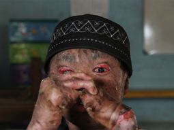 el caso del chico serpiente: cambia de piel cada 40 dias el caso del chico serpiente: cambia de piel cada 40 dias