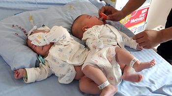 separan a siamesas con la ayuda de la impresion 3d separan a siamesas con la ayuda de la impresion 3d