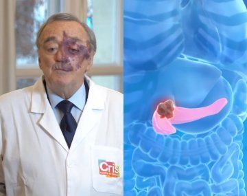 Gran hallazgo: una triple terapia abre una nueva esperanza frente al cáncer de páncreas