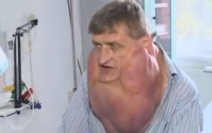 Le extrajeron de la papada un tumor de más de cinco kilos