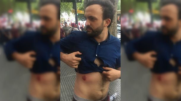 Leonardo Grosso mostró su herida