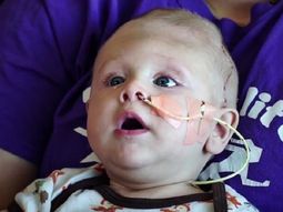 Bebé nació con el cerebro fuera de la cabeza