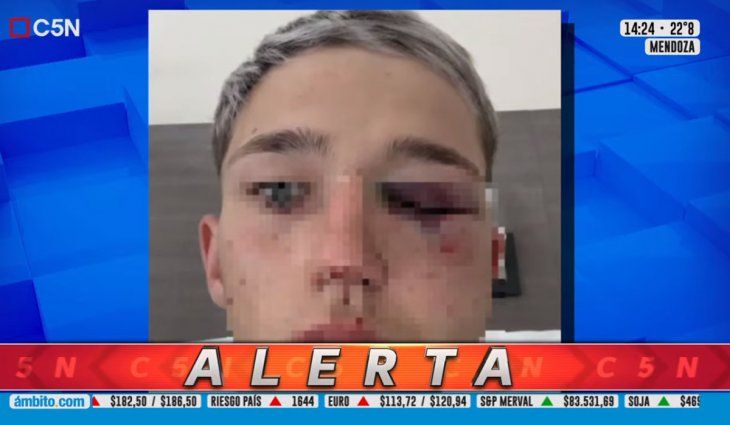 Habló el papá del chico agredido por rugbiers: No tiene sensibilidad en una parte de la cara