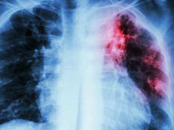 La UBA desarrolla una estrategia innovadora contra la Tuberculosis&nbsp;