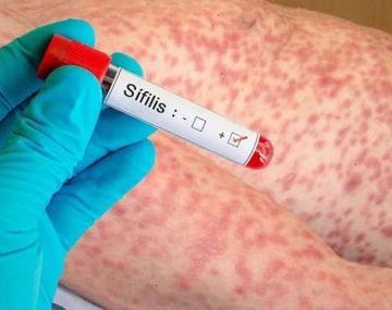 Alerta sanitaria: la sífilis superó los 55 mil casos en el último año en Argentina