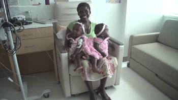 separaron a unas siamesas que estaban unidas por la pelvis separaron a unas siamesas que estaban unidas por la pelvis