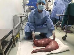 Extirpan un intestino de 13 kg a un hombre que estuvo constipado 20 años