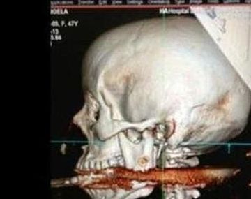 Brasil: un arpón le atravesó la garganta y sobrevivió