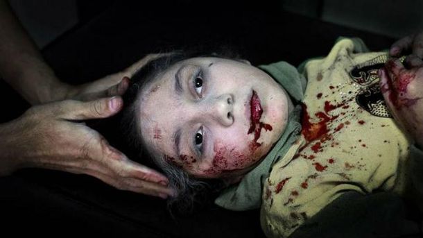 La foto del año 2013 según Unicef: la mirada perdida de una niña herida por una bomba