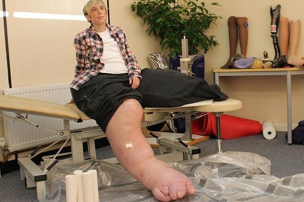 La mujer perdió su pierna izquierda y lucha por la derecha