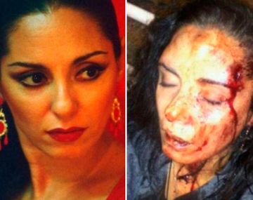 Bailarina de flamenco recibió una brutal golpiza de su ex