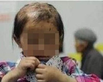 Encuentran una nena llena de cicatrices y la boca cosida