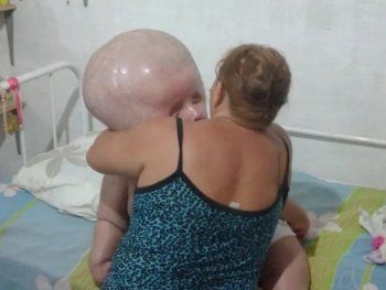 La conmovedora lucha de una joven con hidrocefalia