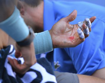 Así está la mano de Nadal antes de enfrentar a Federer