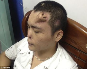 Perdió la nariz y se la reconstruyeron en la frente